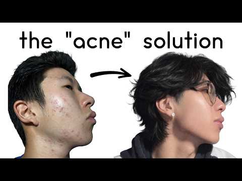 Thumbnail for how to clear up your acne asap by Choice