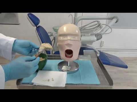 Thumbnail for Vaciado de impresión de silicona by Alejandro Diaz. ETEE. Dental