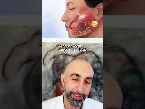 Thumbnail for Do cancerous parotid tumors have any symptoms? #parotid #cancer by LarianMD