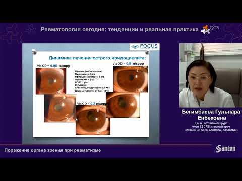 Thumbnail for Конгресс Ревматологов -Поражение органа зрения при ревматизме  Бегимбаева Г Е  Santen by Казахская коллегия ревматологии