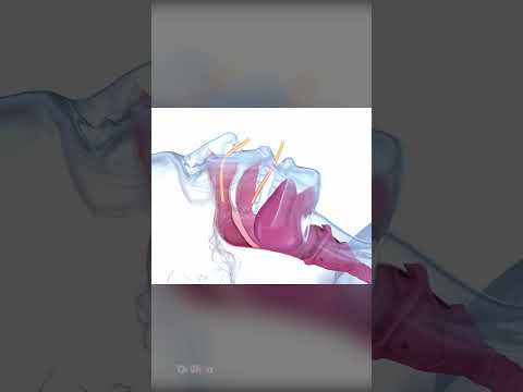 Thumbnail for Sleep Apnea Explained by Dr Wealz