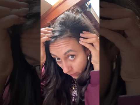 Thumbnail for How I CURED my seborrheic dermatitis and dandruff in 1 week!! by Hola Alexandra