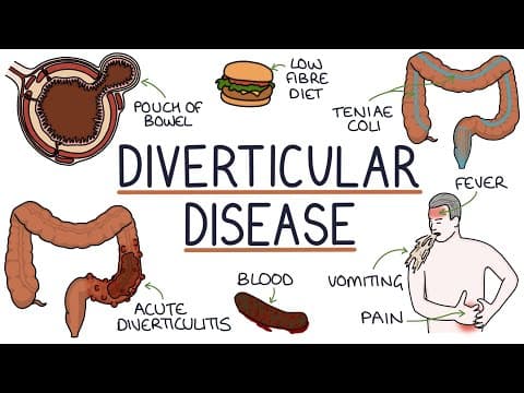 Thumbnail for Understanding Diverticulosis and Diverticulitis by Zero To Finals