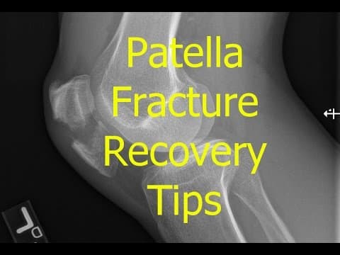 Thumbnail for Patella Fracture Recovery tips by alexkram