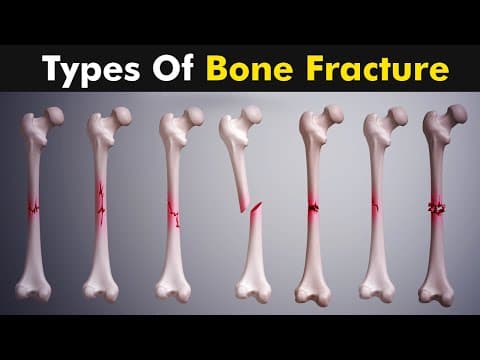 Thumbnail for Common types of Bone fracture | 3D animation | by pOwer Of knOwledge