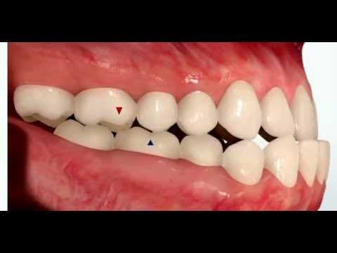 Thumbnail for Class III Malocclusion by Matthew McNutt