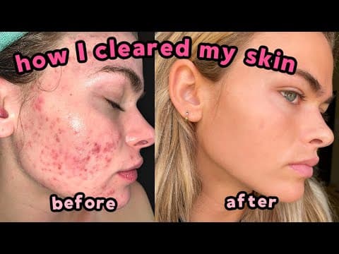 Thumbnail for My Accutane Experience & How I Cleared My Severe Acne + Q&A (with lots of pictures!) by Summer Mckeen
