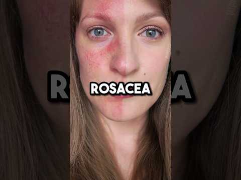 Thumbnail for How to heal rosacea #health #rosacea #guthealth by Juno Wellness