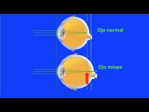 Thumbnail for Optica ocular: miopía, hipermetropía y astigmatismo. Centro de Oftalmología Bonafonte. Barcelona. by Sergio Bonafonte