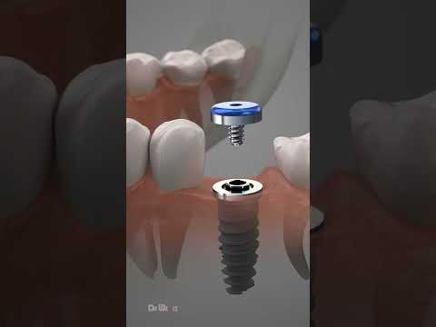 Thumbnail for Dental Implant Procedure by Dr Wealz