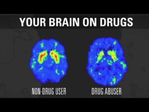 Thumbnail for How addiction changes your brain by CNN