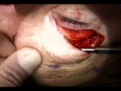Thumbnail for Small incision browplasty with headlight mounted camera by Richard C. Allen MD PhD FACS
