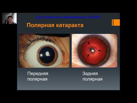 Thumbnail for Катаракта by Кафедра офтальмологии им. Т.И. Ерошевского