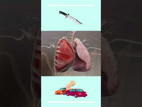 Thumbnail for Hemotórax masivo by MediPerlas