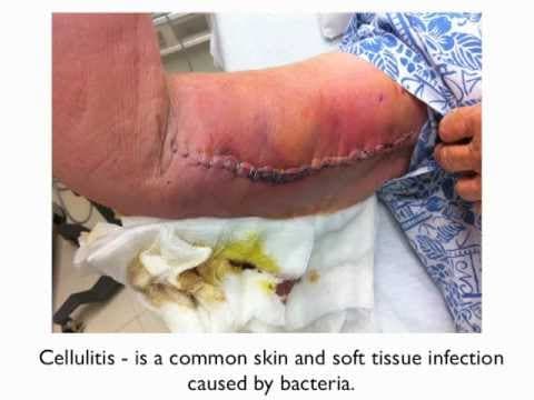 Thumbnail for Cellulitis - a patient education video by DrER.tv