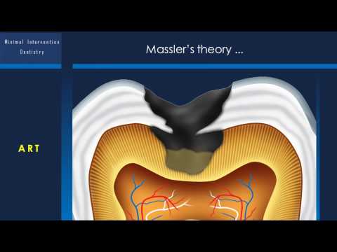 Thumbnail for Minimal Intervention Dentistry | Dr Benin by Smart Dentistry