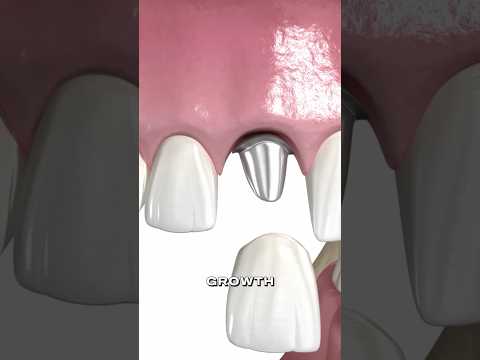 Thumbnail for When There’s Not Enough Bone for Dental Implant by Dr Wealz