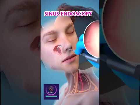 Thumbnail for Sinus Endoscopy Procedure | Nasal Endoscopy for Diagnosis & Treatment by Medical Animation Media